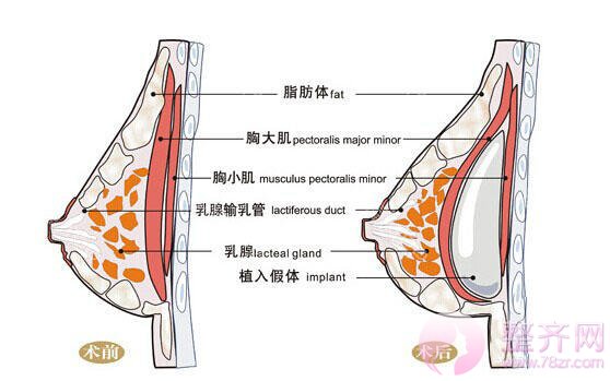 隆胸,你被扣了多少冤枉帽子