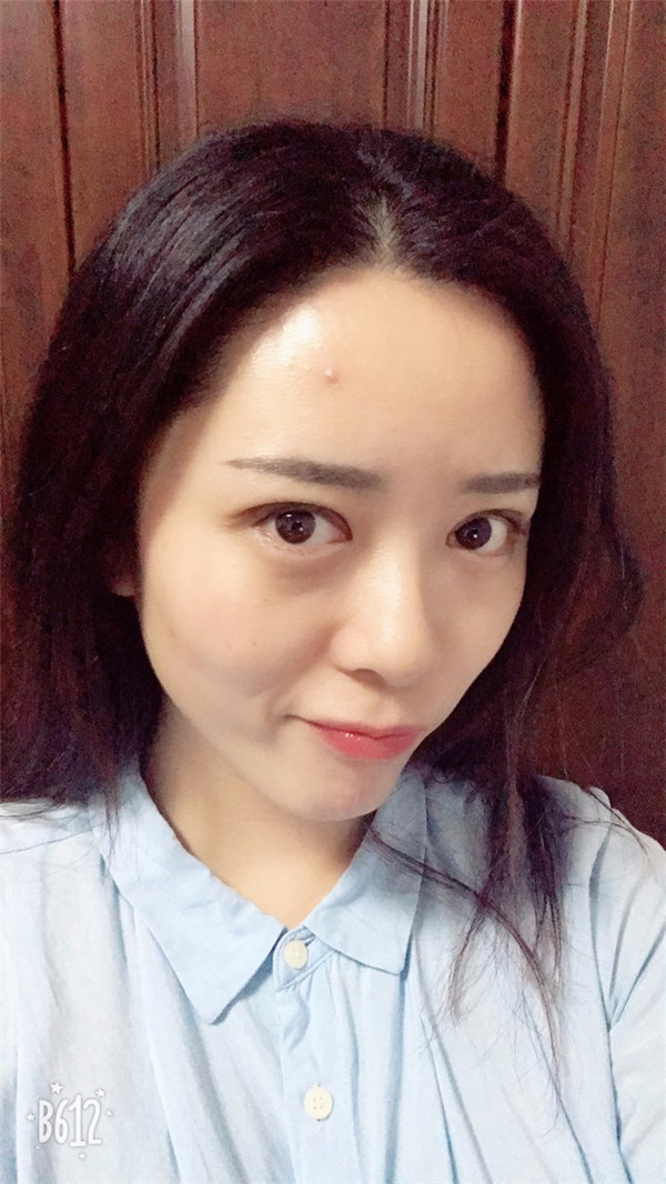 【广州埋线双眼皮案例】今天终于把一直想做的双眼皮做了！做了双眼皮的仙女们也要记得注意保护好眼部，较好等双眼皮消肿了再化妆哦~
