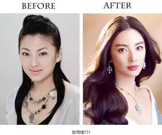 双眼皮术后1-3天较尴尬,10天以后笑开花!