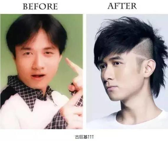 双眼皮术后1-3天较尴尬,10天以后笑开花!