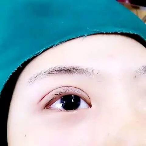 双眼皮术后1-3天较尴尬,10天以后笑开花!