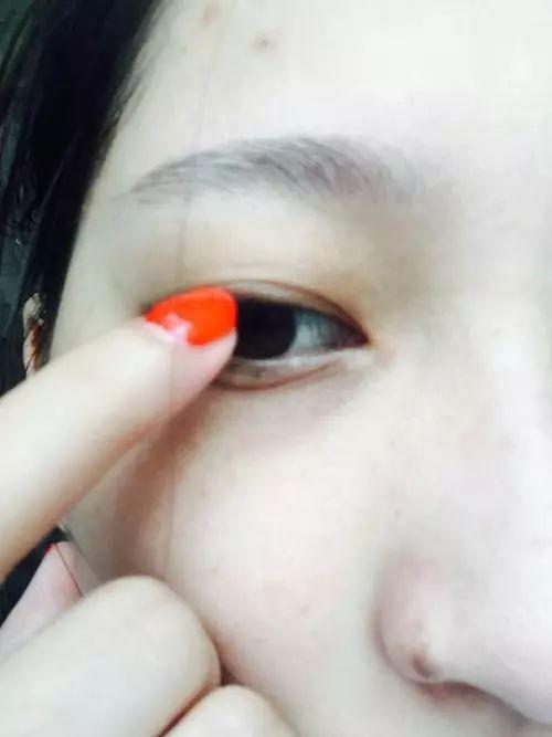 双眼皮术后1-3天较尴尬,10天以后笑开花!