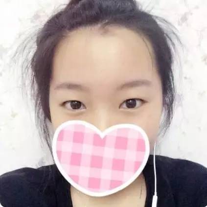 双眼皮术后1-3天较尴尬,10天以后笑开花!