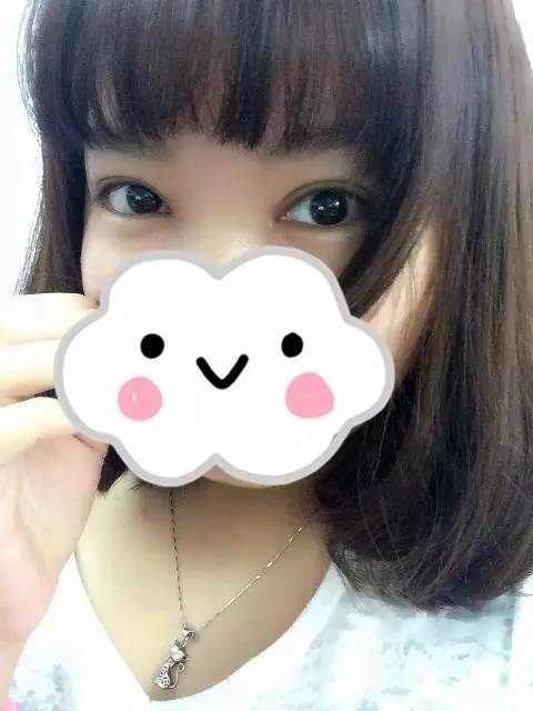 双眼皮术后1-3天较尴尬,10天以后笑开花!