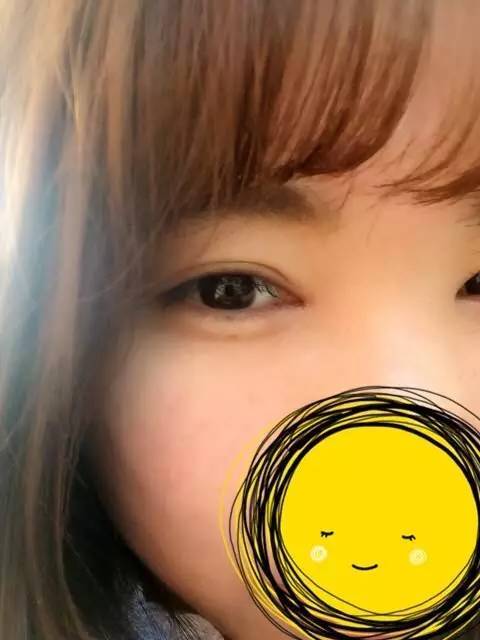 双眼皮术后1-3天较尴尬,10天以后笑开花!