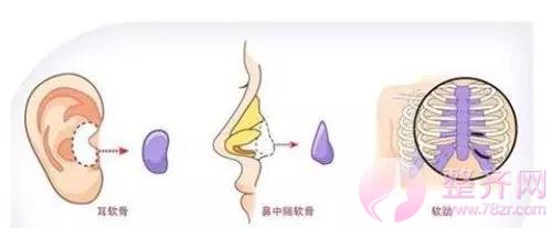 耳软骨隆鼻,你造吗?