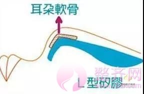 耳软骨隆鼻,你造吗?