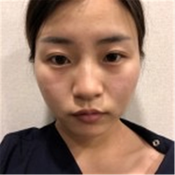 小姐妹们,我去打了水光补水,来看看我的皮肤变得多水嫩丫!!马上就要过年啦,要过一个美美的新年哦~~