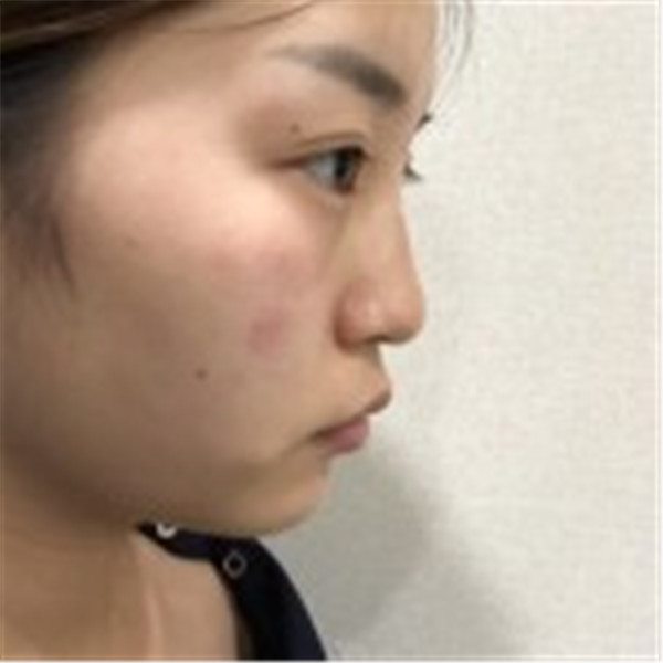 小姐妹们,我去打了水光补水,来看看我的皮肤变得多水嫩丫!!马上就要过年啦,要过一个美美的新年哦~~