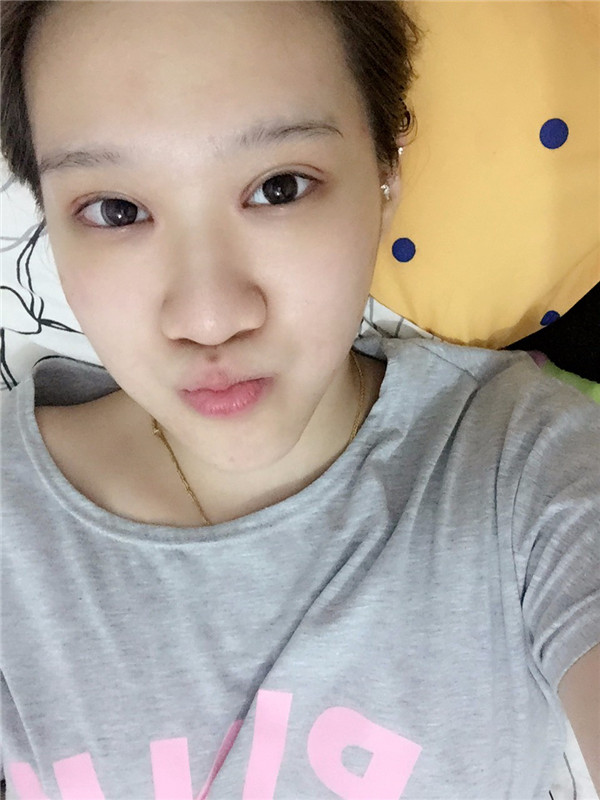 【眼部手术手术】宝宝们,大家好,我来啦~我做的是眼部手术,恢复的很好哦,进来看看我的经历吧!对你们很有帮助的