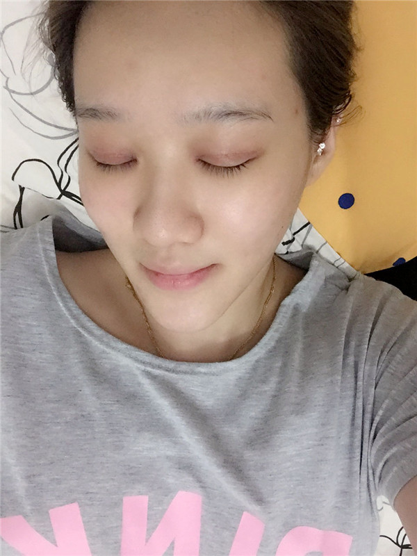 【眼部手术手术】宝宝们,大家好,我来啦~我做的是眼部手术,恢复的很好哦,进来看看我的经历吧!对你们很有帮助的