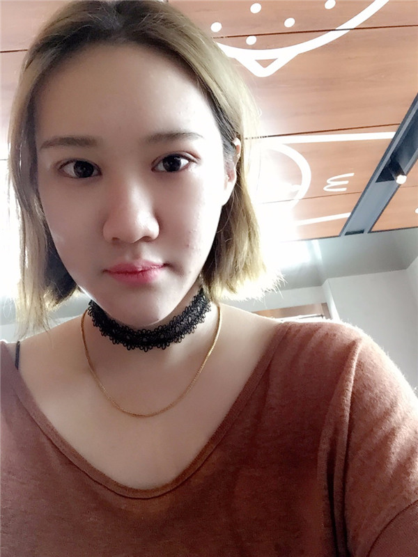 【眼部手术手术】宝宝们,大家好,我来啦~我做的是眼部手术,恢复的很好哦,进来看看我的经历吧!对你们很有帮助的