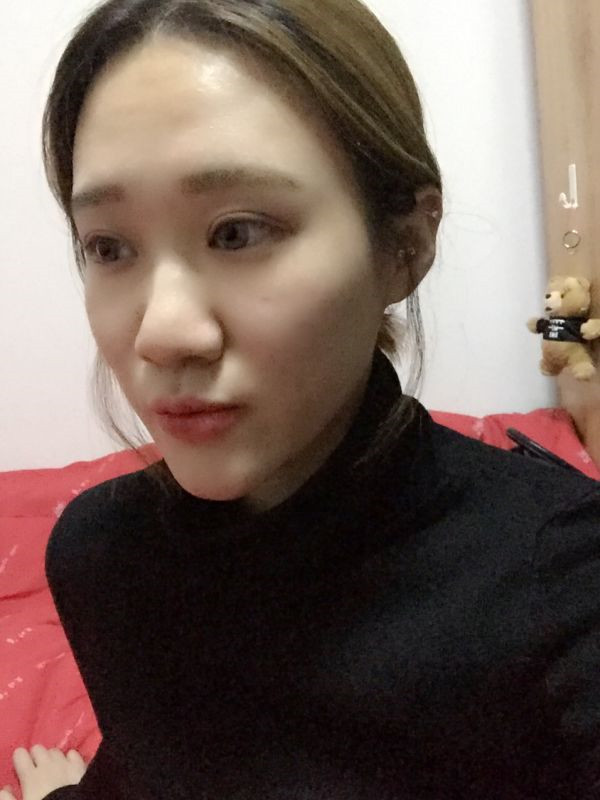 【眼部手术手术】宝宝们,大家好,我来啦~我做的是眼部手术,恢复的很好哦,进来看看我的经历吧!对你们很有帮助的