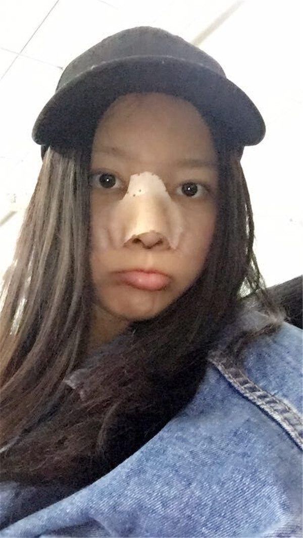 【我的假体隆鼻案例】新年快乐呀宝宝们,我来和大家分享我的隆鼻日记了,我自己恢复得不错,所以放心大胆的将自己的鼻子交给医院啦~