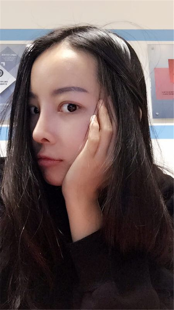 【我的假体隆鼻案例】新年快乐呀宝宝们,我来和大家分享我的隆鼻日记了,我自己恢复得不错,所以放心大胆的将自己的鼻子交给医院啦~