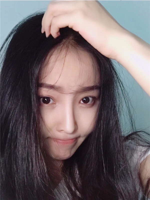 【我的假体隆鼻案例】新年快乐呀宝宝们,我来和大家分享我的隆鼻日记了,我自己恢复得不错,所以放心大胆的将自己的鼻子交给医院啦~