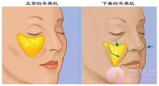 苹果肌到底好在哪里?