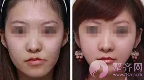 苹果肌到底好在哪里?