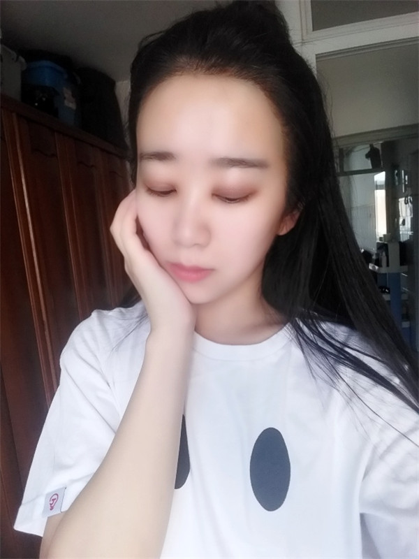 【分享案例】给宝宝们分享我的双眼皮之路啦!宝宝们我做双眼皮是打的局麻,其实局麻一点都不痛就跟蚊子叮差不多,不是特别注意完完全全就感觉不到