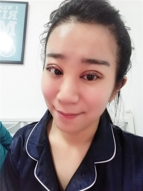 【分享案例】给宝宝们分享我的双眼皮之路啦!宝宝们我做双眼皮是打的局麻,其实局麻一点都不痛就跟蚊子叮差不多,不是特别注意完完全全就感觉不到