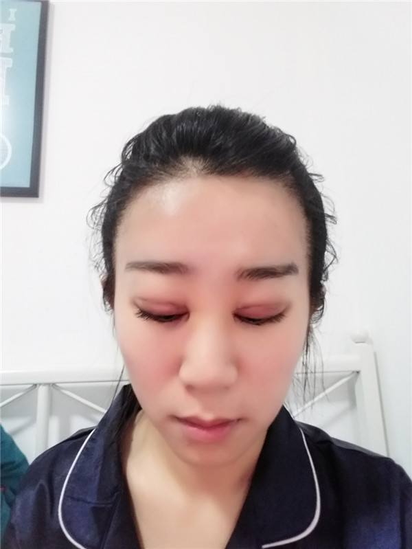 【分享案例】给宝宝们分享我的双眼皮之路啦!宝宝们我做双眼皮是打的局麻,其实局麻一点都不痛就跟蚊子叮差不多,不是特别注意完完全全就感觉不到