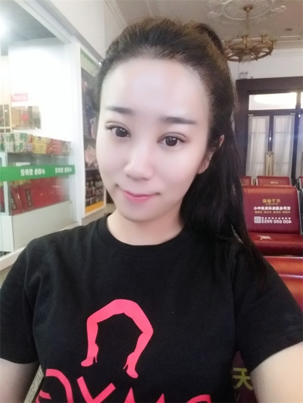 【分享案例】给宝宝们分享我的双眼皮之路啦!宝宝们我做双眼皮是打的局麻,其实局麻一点都不痛就跟蚊子叮差不多,不是特别注意完完全全就感觉不到