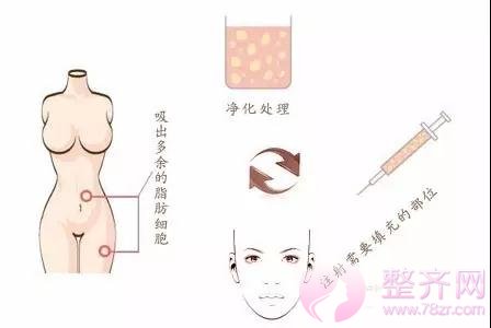 做面部填充,自体脂肪与玻尿酸有什么差别?