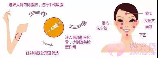 做面部填充,自体脂肪与玻尿酸有什么差别?
