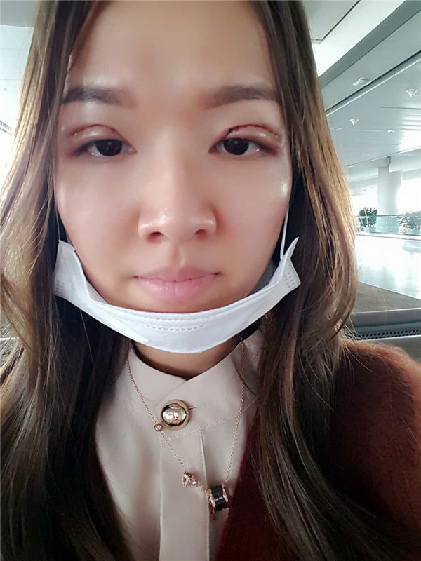 【全切+祛皮祛脂】分享我的术后恢复小妙招!宝宝们刚做完手术的前几天因为眼睛肿胀的厉害会比较丑,过了这几天后期慢慢消肿会越来越自然的。