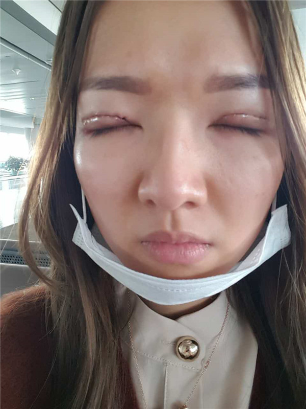 【全切+祛皮祛脂】分享我的术后恢复小妙招!宝宝们刚做完手术的前几天因为眼睛肿胀的厉害会比较丑,过了这几天后期慢慢消肿会越来越自然的。