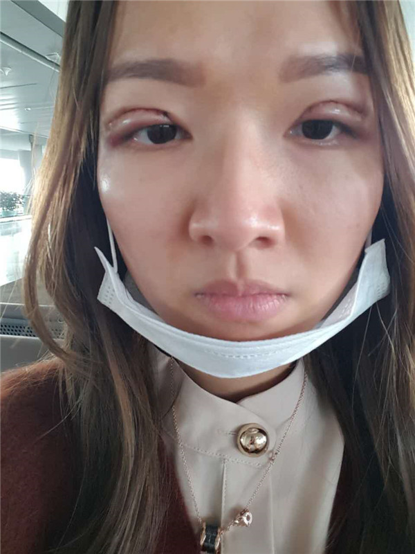 【全切+祛皮祛脂】分享我的术后恢复小妙招!宝宝们刚做完手术的前几天因为眼睛肿胀的厉害会比较丑,过了这几天后期慢慢消肿会越来越自然的。