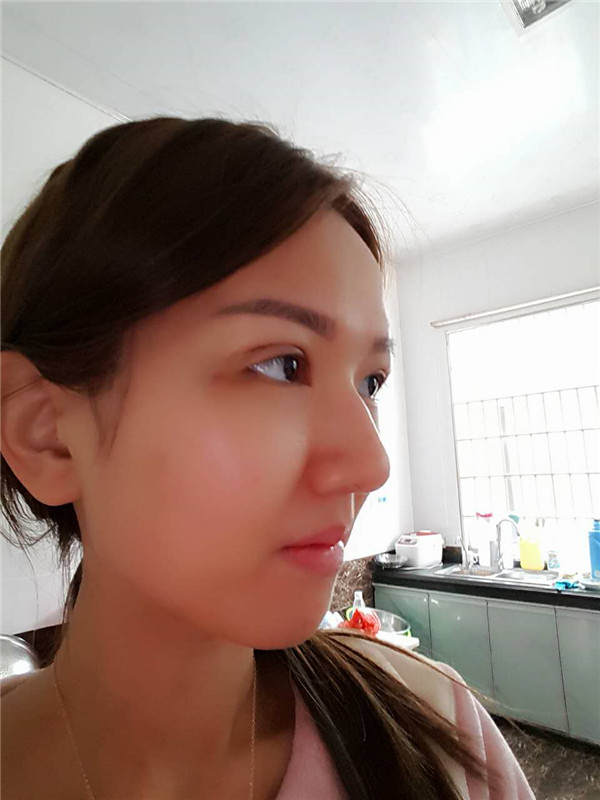 【全切+祛皮祛脂】分享我的术后恢复小妙招!宝宝们刚做完手术的前几天因为眼睛肿胀的厉害会比较丑,过了这几天后期慢慢消肿会越来越自然的。