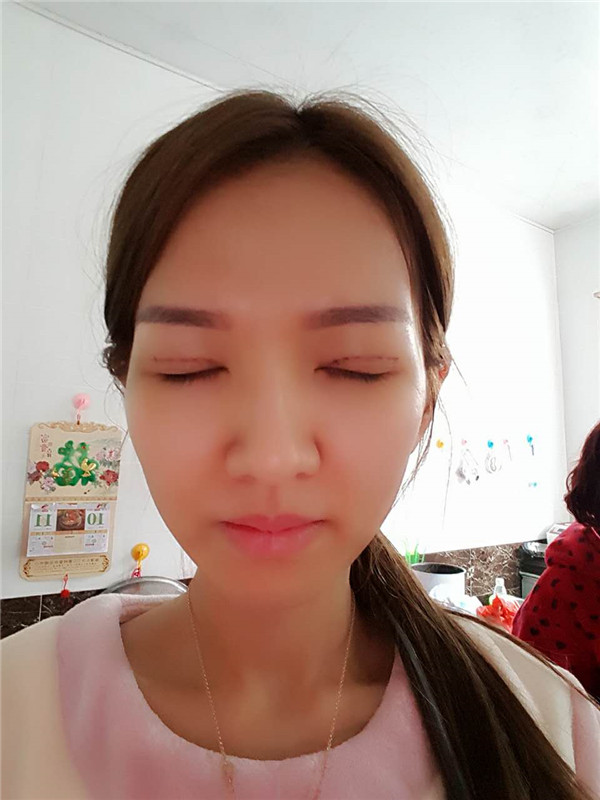 【全切+祛皮祛脂】分享我的术后恢复小妙招!宝宝们刚做完手术的前几天因为眼睛肿胀的厉害会比较丑,过了这几天后期慢慢消肿会越来越自然的。