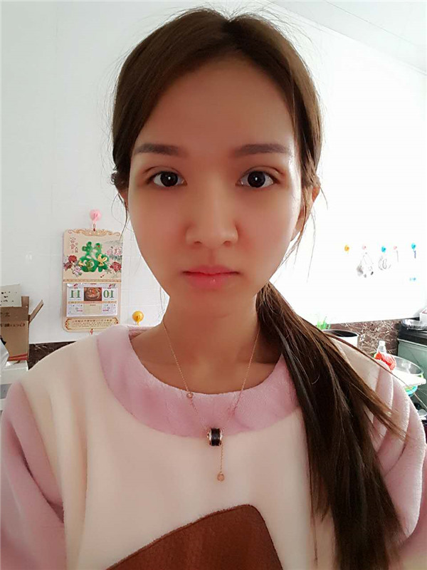 【全切+祛皮祛脂】分享我的术后恢复小妙招!宝宝们刚做完手术的前几天因为眼睛肿胀的厉害会比较丑,过了这几天后期慢慢消肿会越来越自然的。
