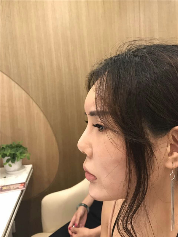 【鼻部手术】小仙女们,做完手术第一天就迫不及待想把自己这次的经历分享给大家了~~~我先放一些我的照片让宝宝们看看我的恢复情况