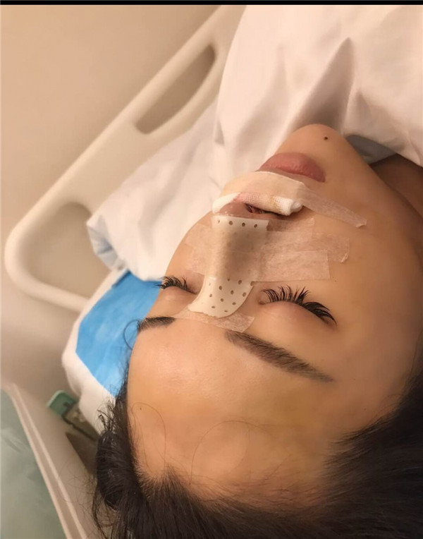 【鼻部手术】小仙女们,做完手术第一天就迫不及待想把自己这次的经历分享给大家了~~~我先放一些我的照片让宝宝们看看我的恢复情况