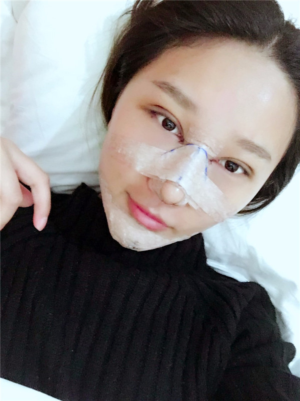 【双眼皮+隆鼻术】春节长假过完啦,亲朋好友们都夸我变漂亮了,一条精致的线,就能够让眼睛瞬间变大、变亮、变漂亮!