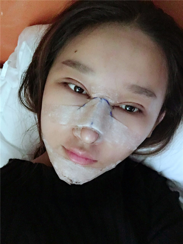 【双眼皮+隆鼻术】春节长假过完啦,亲朋好友们都夸我变漂亮了,一条精致的线,就能够让眼睛瞬间变大、变亮、变漂亮!