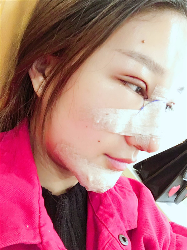 【双眼皮+隆鼻术】春节长假过完啦,亲朋好友们都夸我变漂亮了,一条精致的线,就能够让眼睛瞬间变大、变亮、变漂亮!