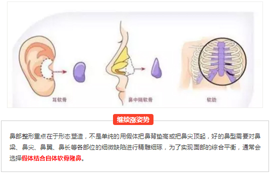 隆鼻宛如爱情,适合自己的才是较好的