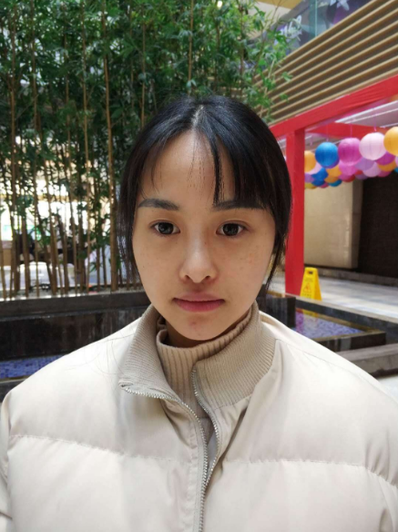 北京知音埋线提升提升一个月案例分享,做一个漂亮全新的自己。