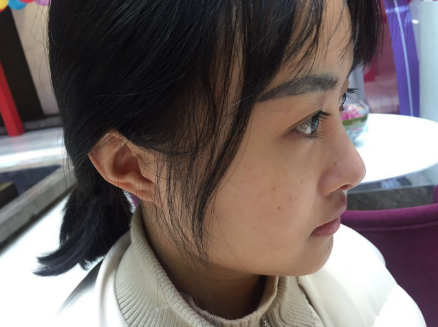 北京知音埋线提升提升一个月案例分享,做一个漂亮全新的自己。