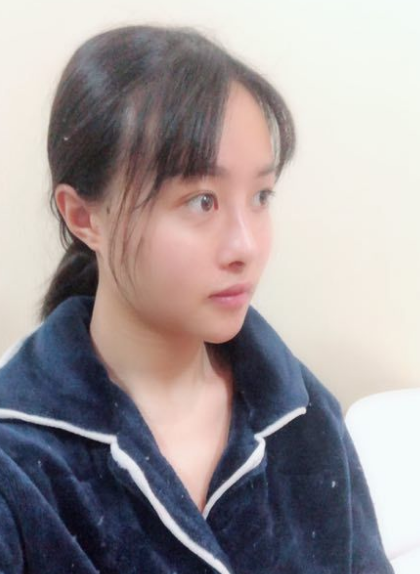 北京知音埋线提升提升一个月案例分享,做一个漂亮全新的自己。