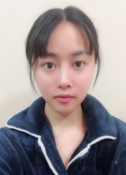 北京知音埋线提升提升一个月案例分享,做一个漂亮全新的自己。