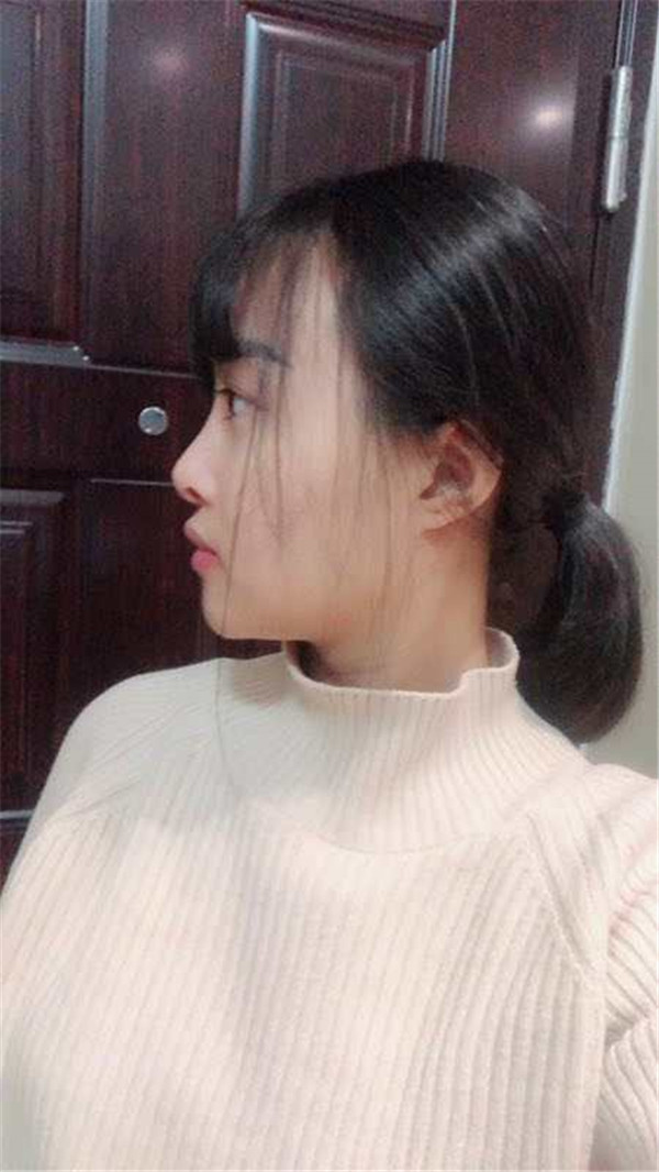 北京知音埋线提升提升一个月案例分享,做一个漂亮全新的自己。