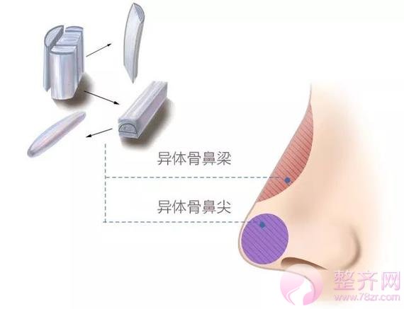 异体肋软骨隆鼻,真的行得通吗?