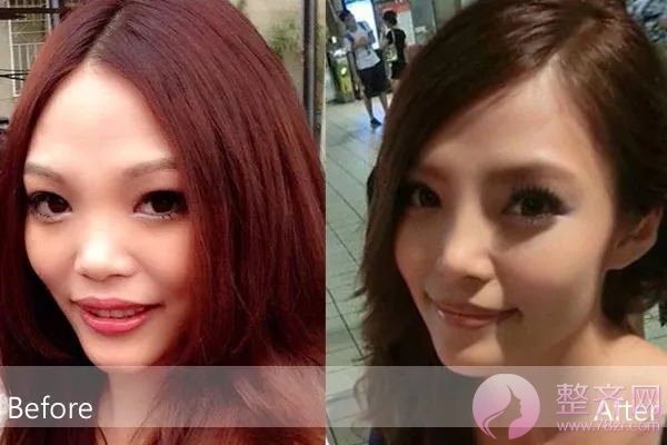 异体肋软骨隆鼻,真的行得通吗?