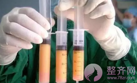 自体脂肪隆胸后,捏起来是什么感觉?