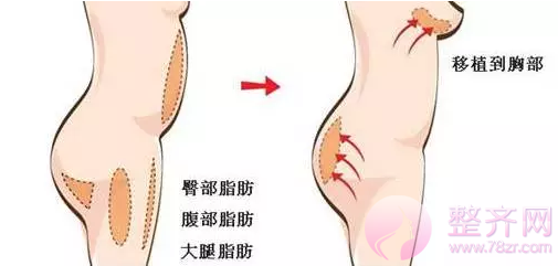 自体脂肪隆胸后,捏起来是什么感觉?