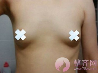自体脂肪隆胸后,捏起来是什么感觉?